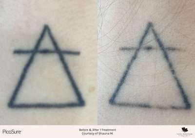 Tattoo removal first session results. Before and after PicoSure tattoo removal service.