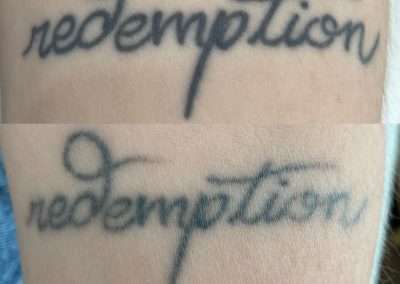 laser tattoo removal before and after of client.