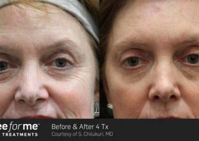 ThreeForMe before and after results of 4 treatments. Pigmentation treatment.