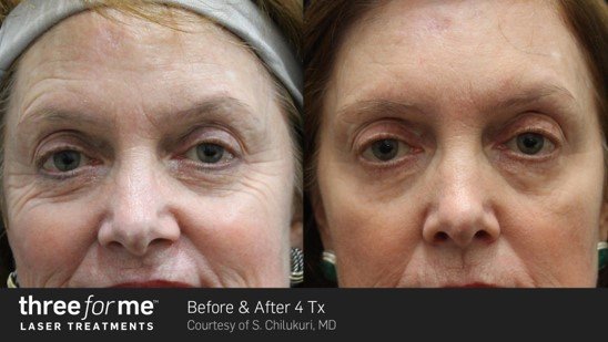 ThreeForMe before and after results of 4 treatments. Pigmentation treatment.