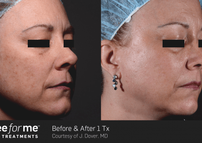 ThreeForMe before and after results on woman's face. Discolouration treatment.