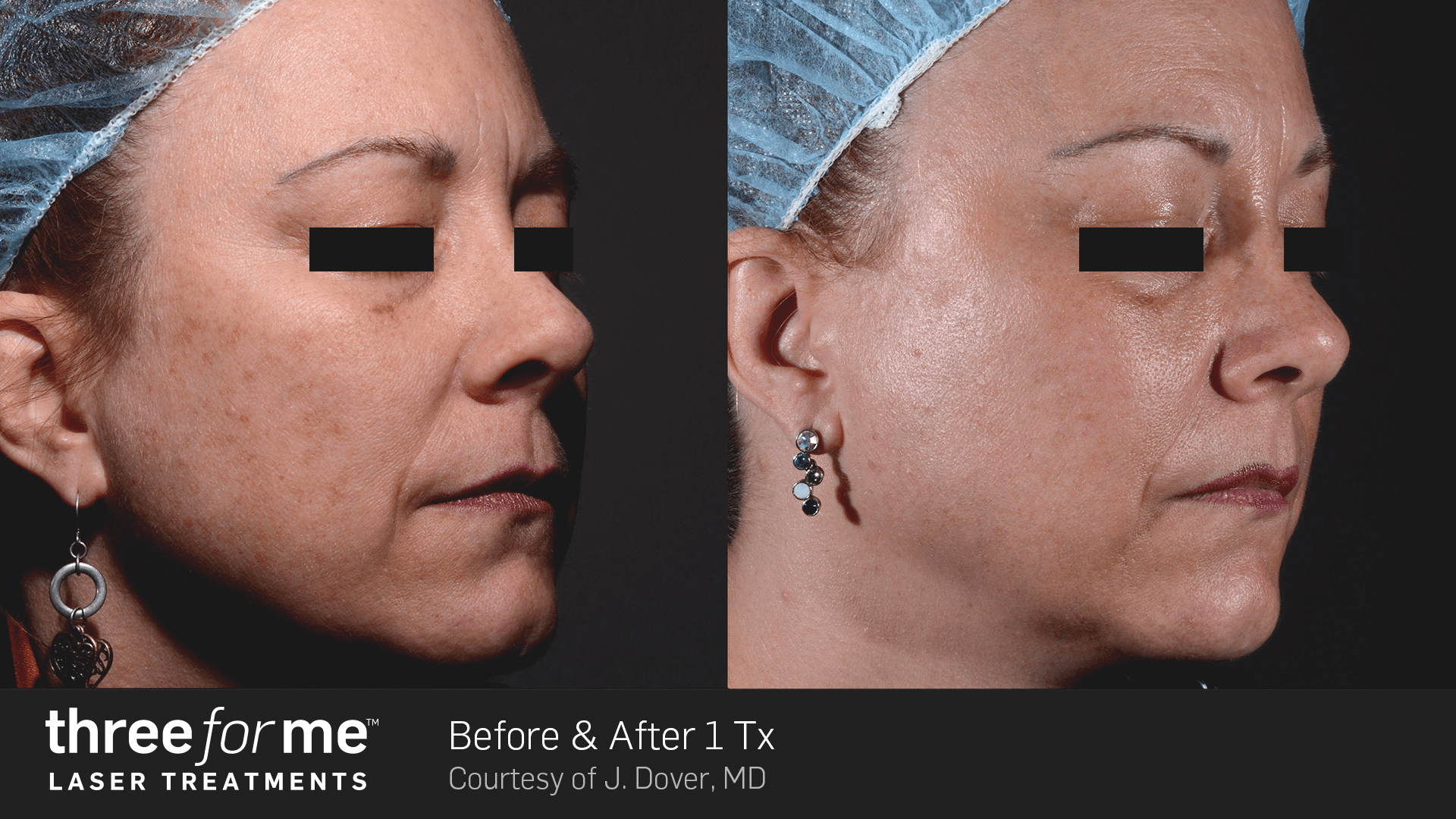 ThreeForMe before and after results on woman's face
