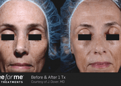 ThreeForMe before and after results after 1 treatment. Removal of pigmentation