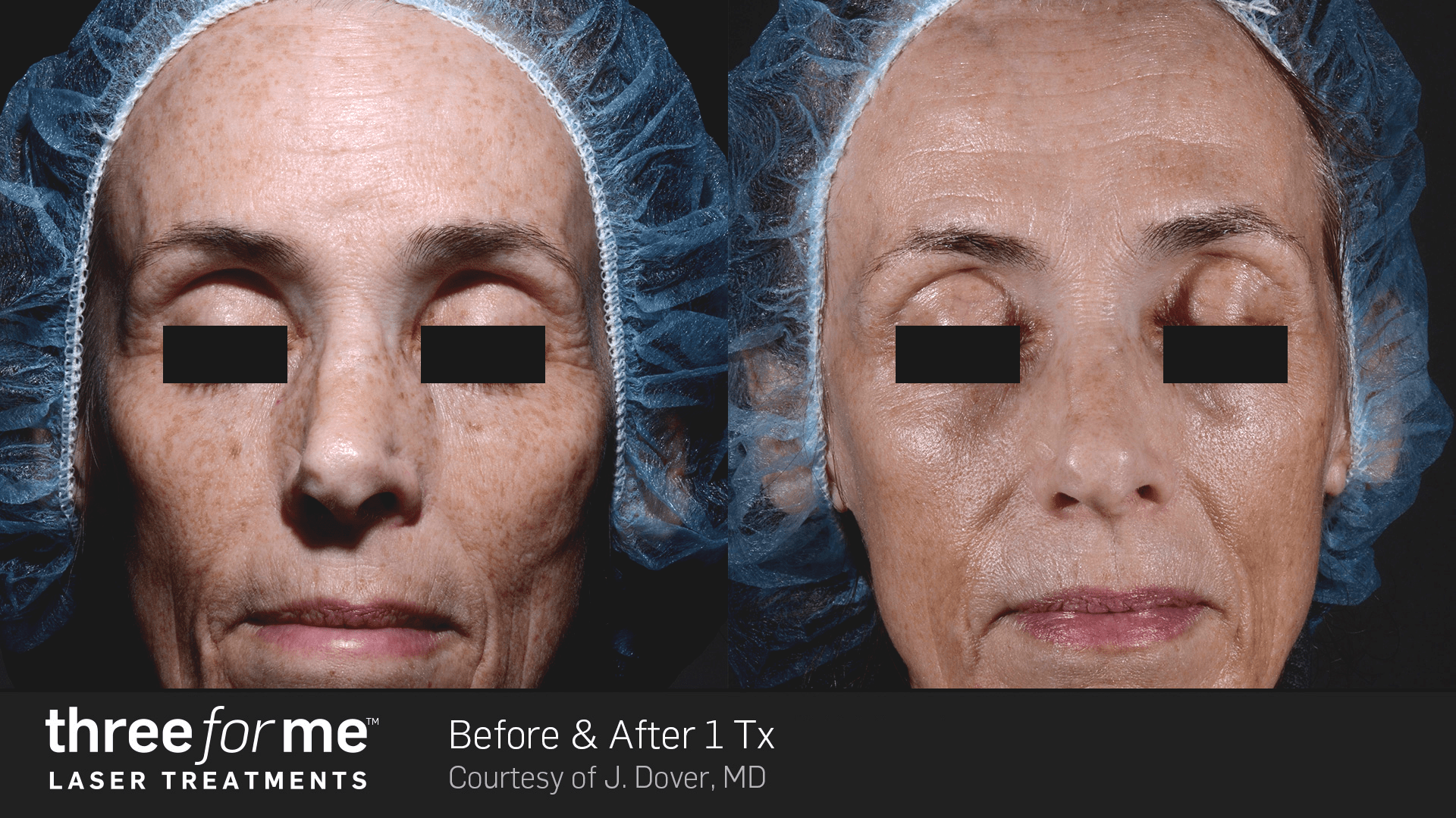 ThreeForMe before and after results after 1 treatment. Removal of pigmentation, courtesy of J. Dover, MD