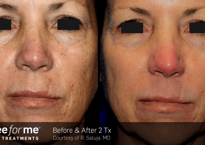 ThreeForMe before and after results of 2 treatments.
