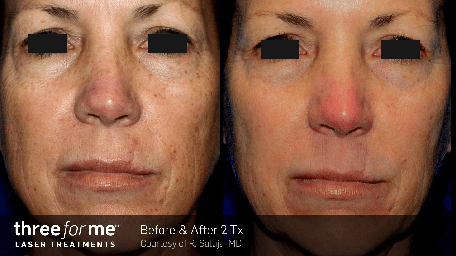 ThreeForMe before and after results of 2 treatments. Courtesy of R. Saluja, MD
