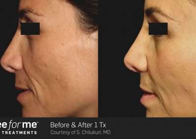 ThreeforMe before and after results of 1 treatment on client.