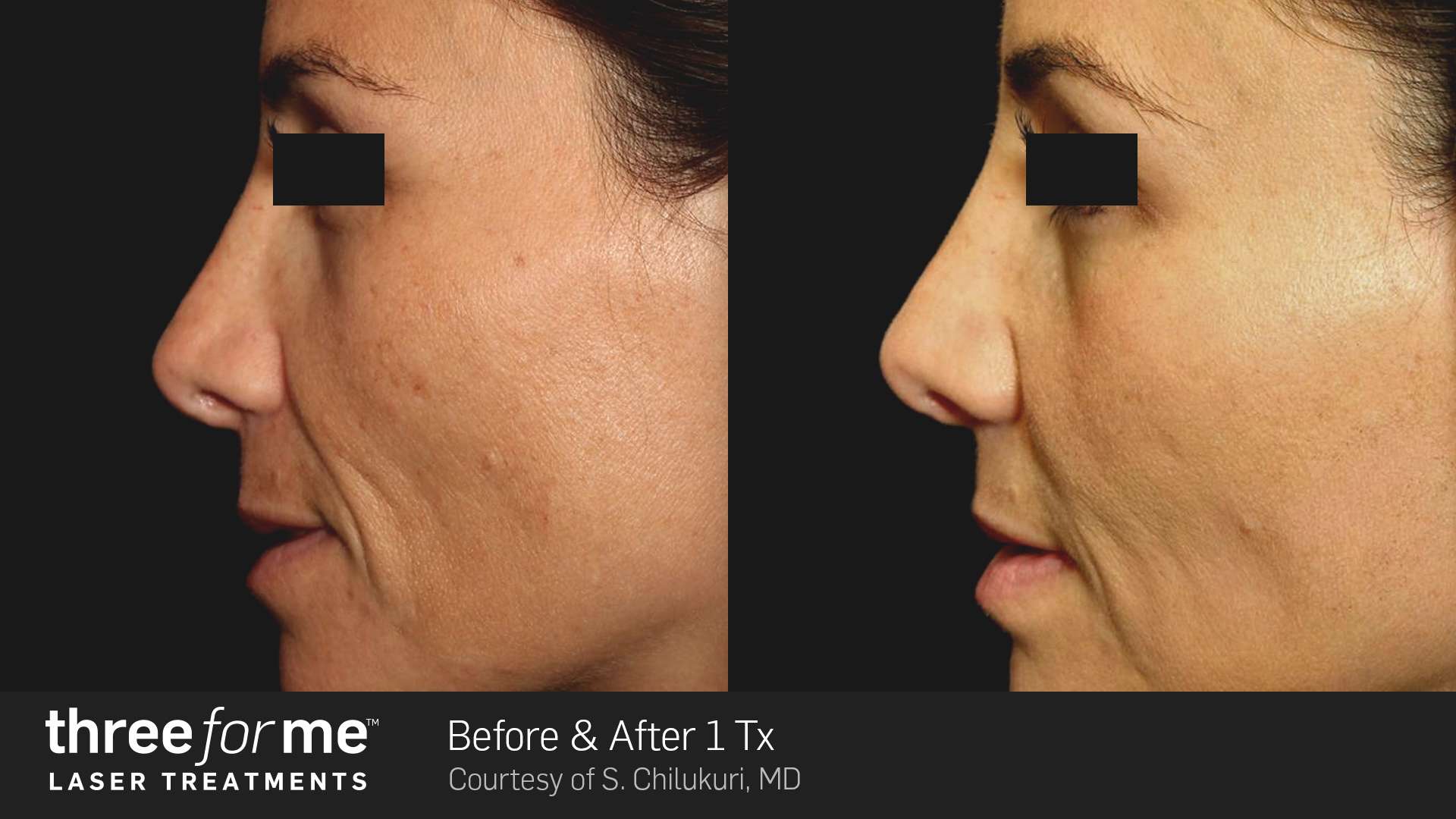 ThreeforMe before and after results of 1 treatment. Courtesy of S. Chilukuri, MD.
