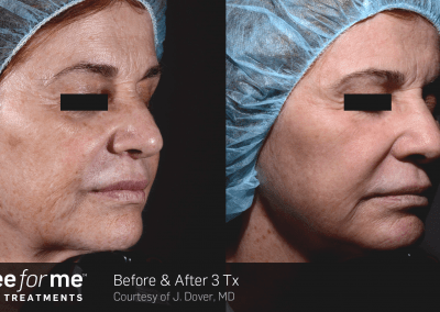 ThreeForMe service ant before and after 3 treatments.