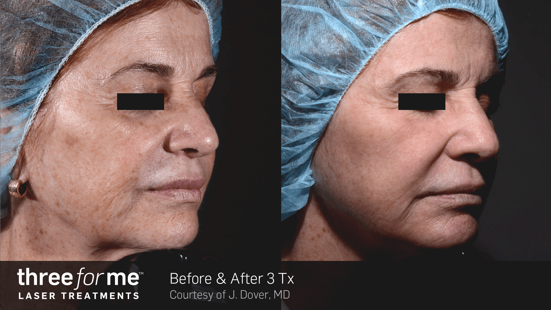 ThreeForMe results, before and after 3 treatments. Courtesy of J. Dover, MD