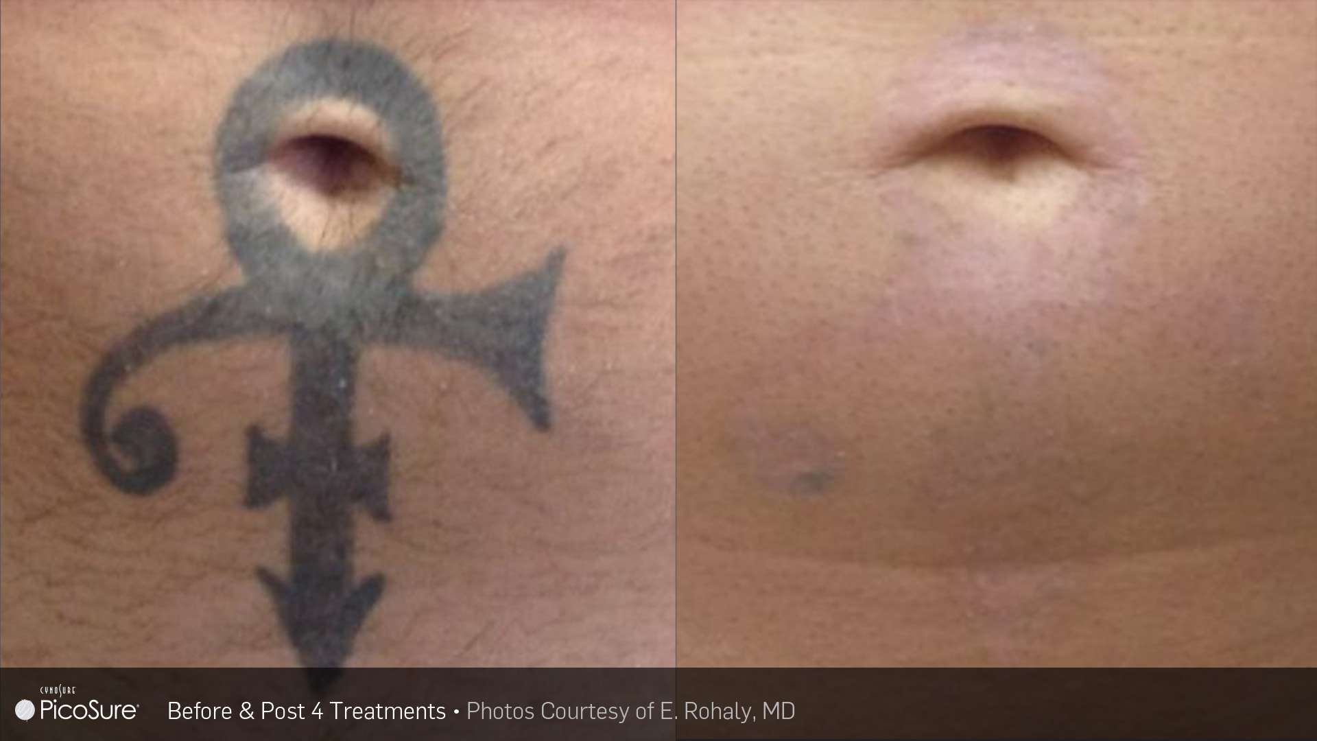 Before and after of tattoo removal of black ink tattoo around belly button area. Tattoo was removed.