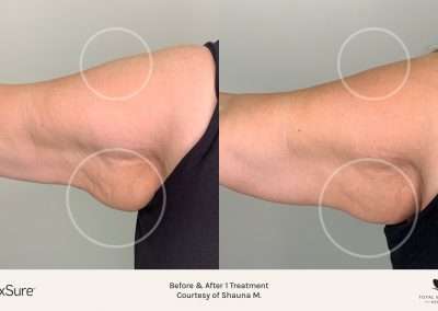 before and after body contouring