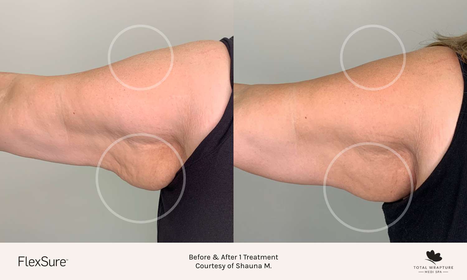 before and after body contouring