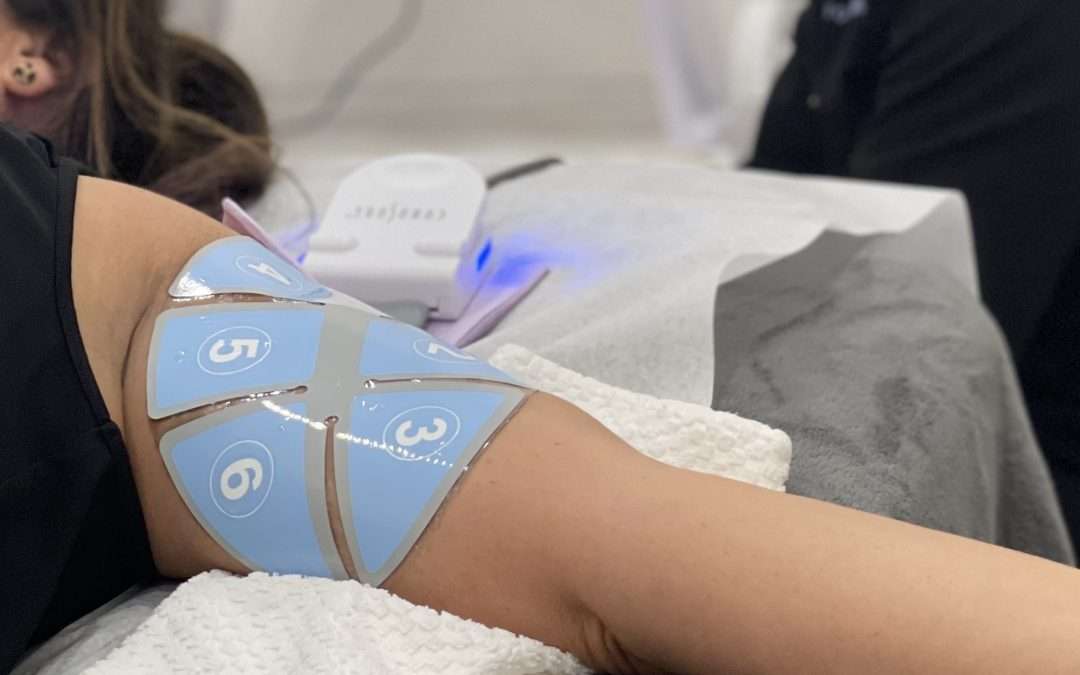 woman getting a flexsure treatment