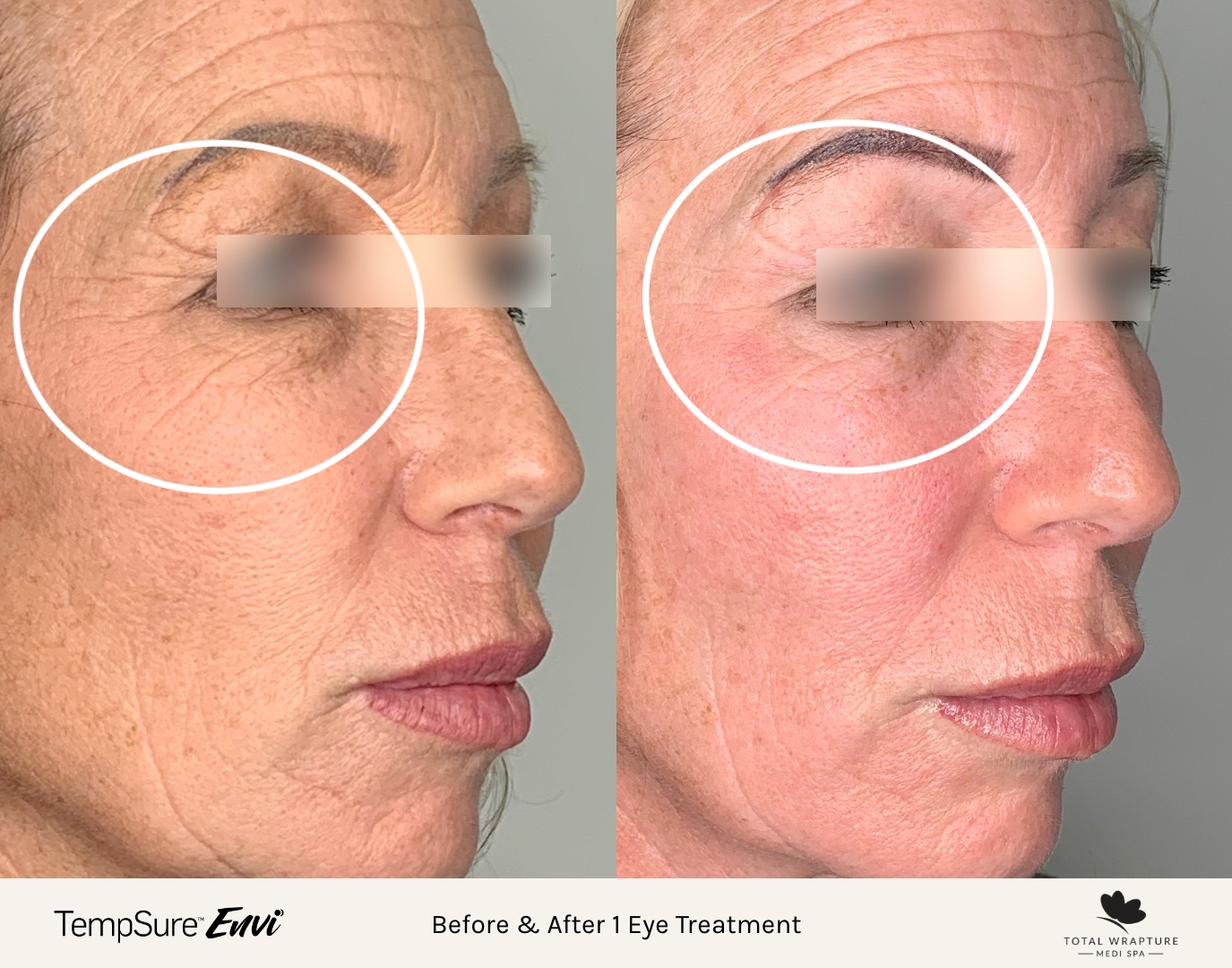Tempsure envi skin tightening treatment on eyes. Before and after results.