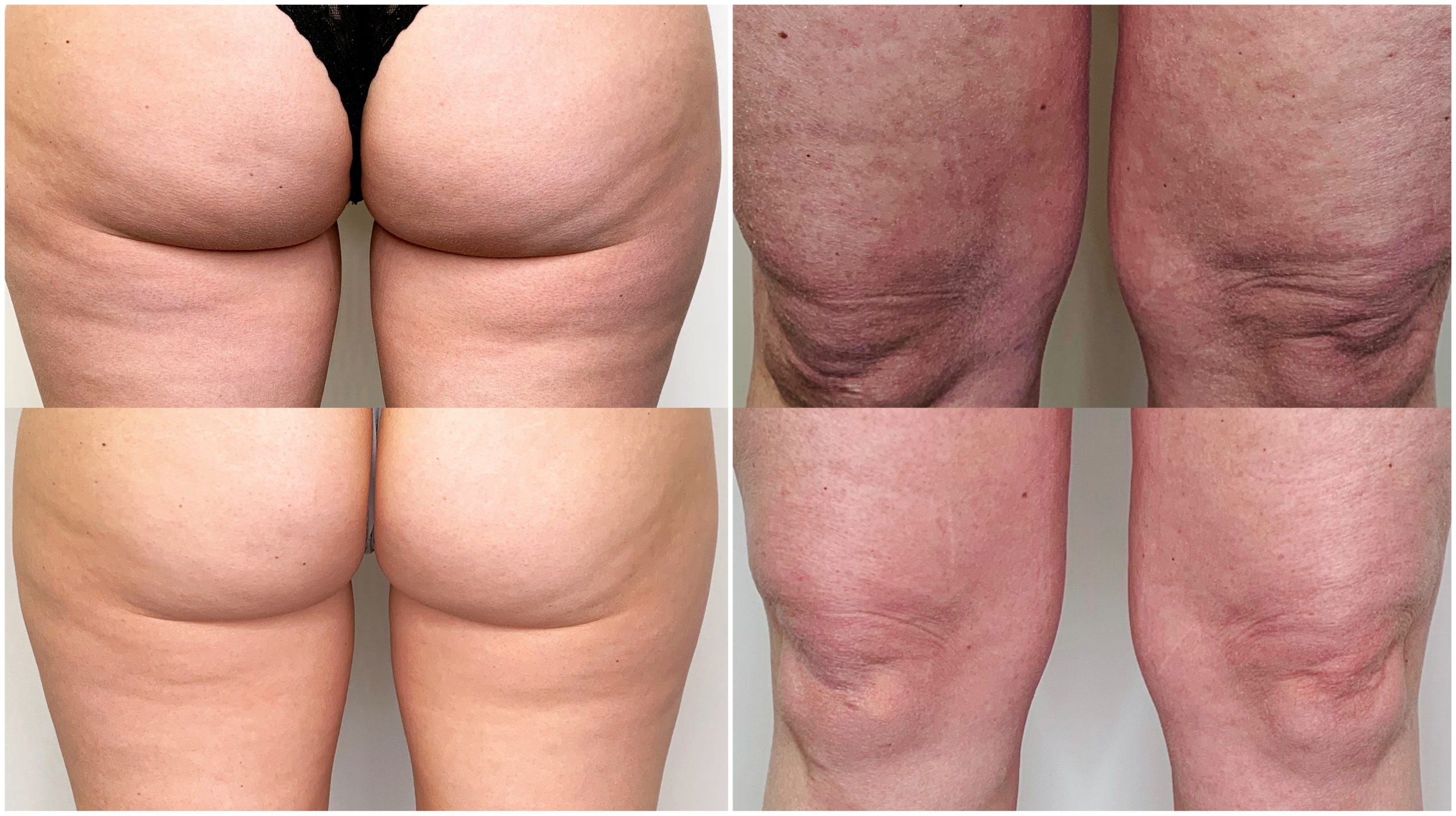 radiofrequency cellulite treatment in winnipeg