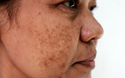 Melasma and Laser Treatments: What You Should Know