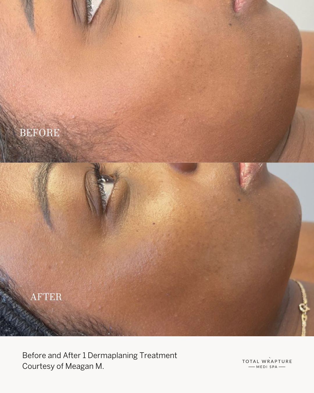 Dermaplaning before and after