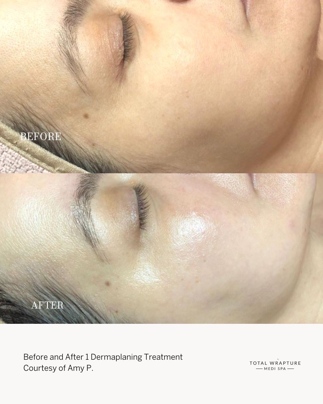 Dermaplaning before and after results