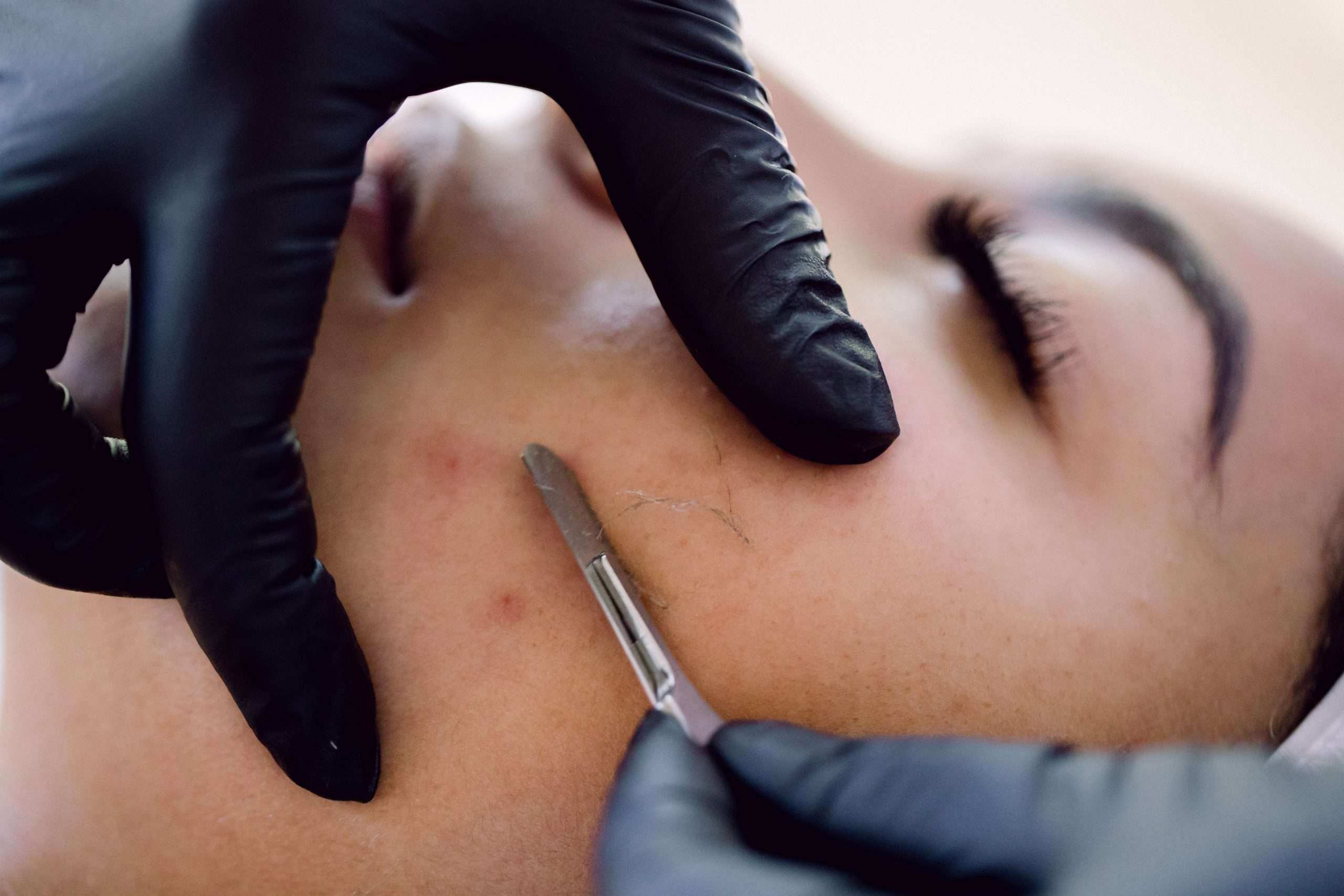 Dermaplaning facial on client's cheek. Facial treatments in Winnipeg