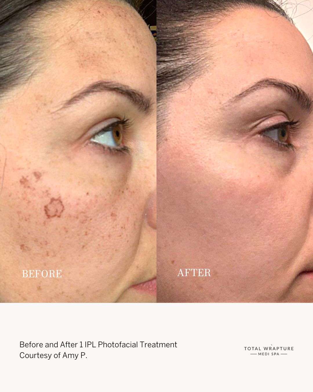 ipl photofacial before and after on client's cheek