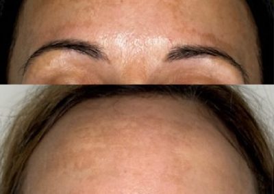 Winnipeg Melasma Laser Treatment Results