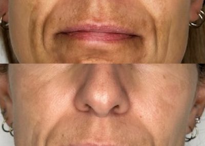 Winnipeg Melasma Laser Treatment Results before and after results