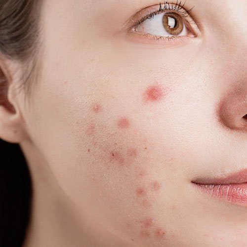 Acne solutions at Total Wrapture Medi Spa in Winnipeg, Manitoba