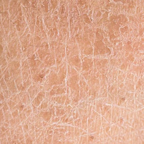 Dehydrated skin solutions at Total Wrapture Medi Spa in Winnipeg, Manitoba