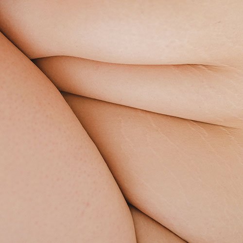 Loose skin solutions at Total Wrapture Medi Spa in Winnipeg, Manitoba