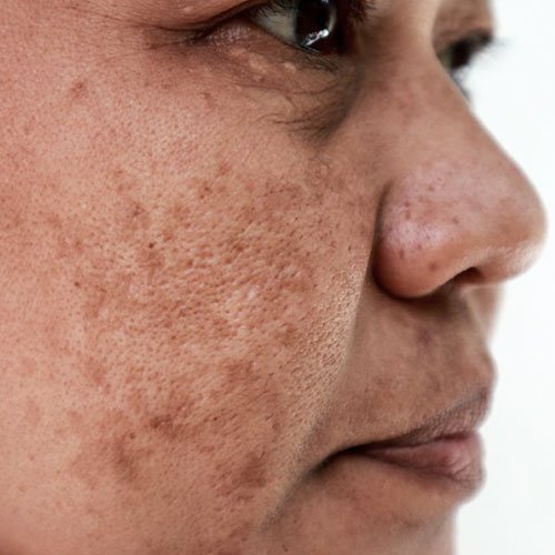 Melasma and pigmentation solutions at Total Wrapture Medi Spa in Winnipeg, Manitoba