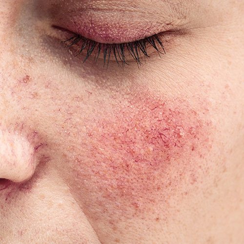 Rosacea solutions at Total Wrapture Medi Spa in Winnipeg, Manitoba