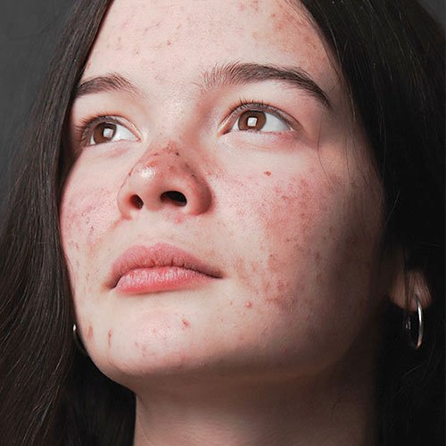 Scar treatments at Total Wrapture Medi Spa in Winnipeg, Manitoba