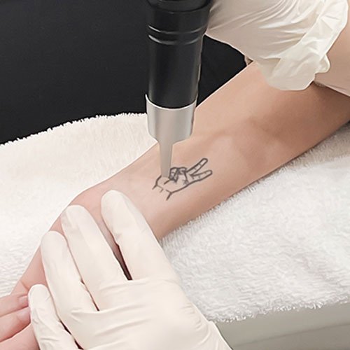 Laser tattoo removal solutions at Total Wrapture Medi Spa in Winnipeg, Manitoba