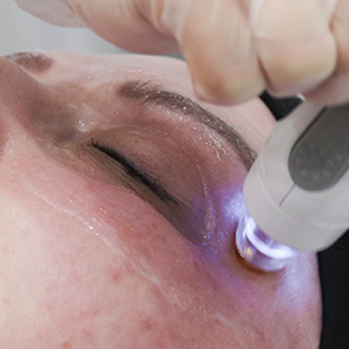 Undereye bags and dark circle solutions at Total Wrapture Medi Spa in Winnipeg Manitoba