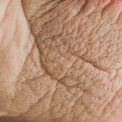 Wrinkle solutions at Total Wrapture Medi Spa in Winnipeg Manitoba