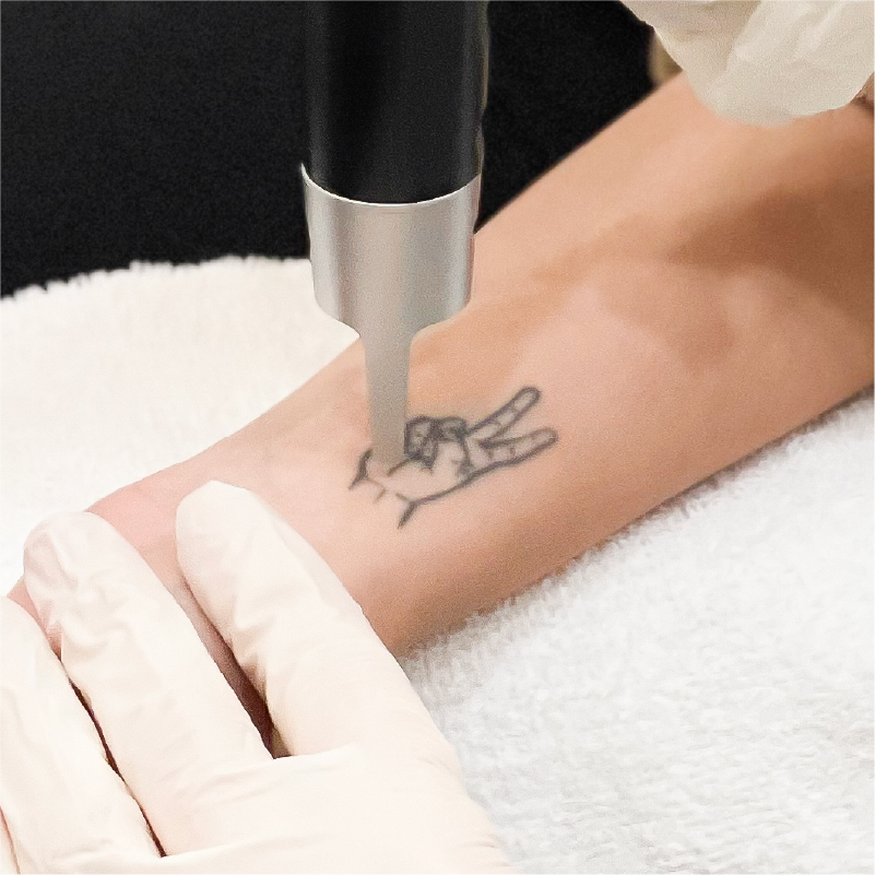 Laser tattoo removal services in Winnipeg