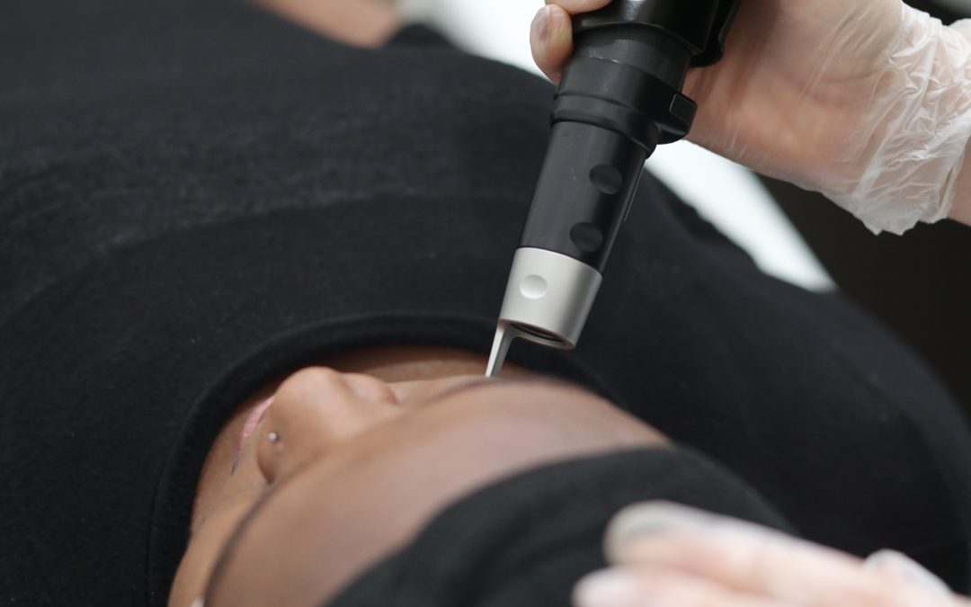 treating acne scars with picosure laser on client's face