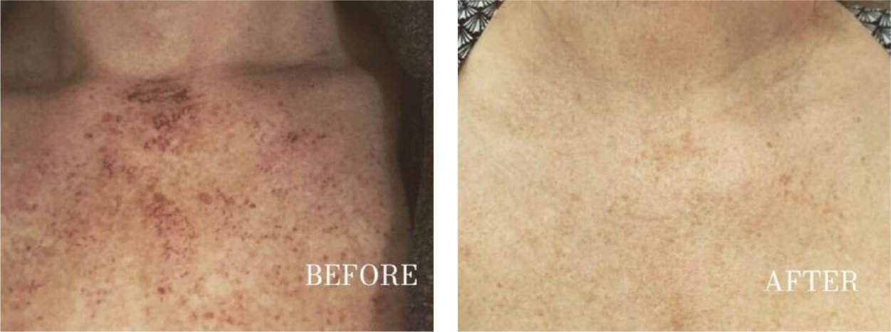 before and after a photofacial treatment on client's decollete