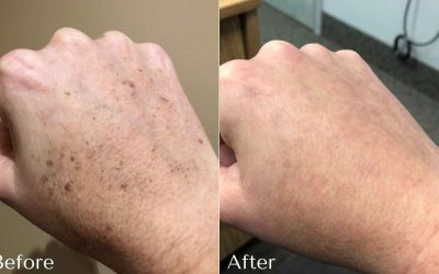 3 Ways to Treat Age Spots