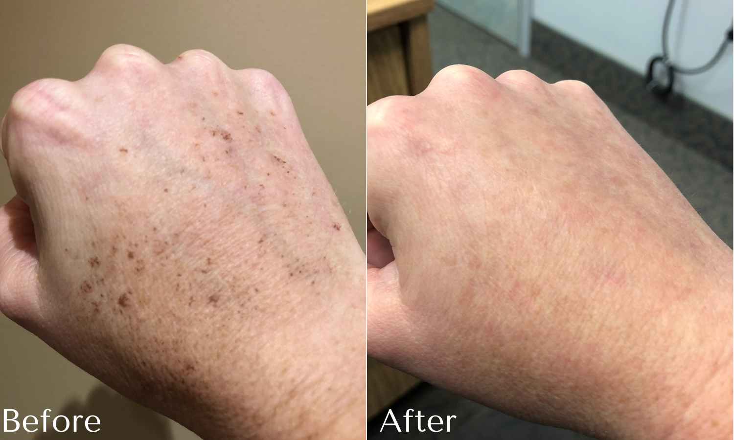 photofacial before and after results on hand