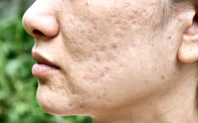 Do acne scars go away?