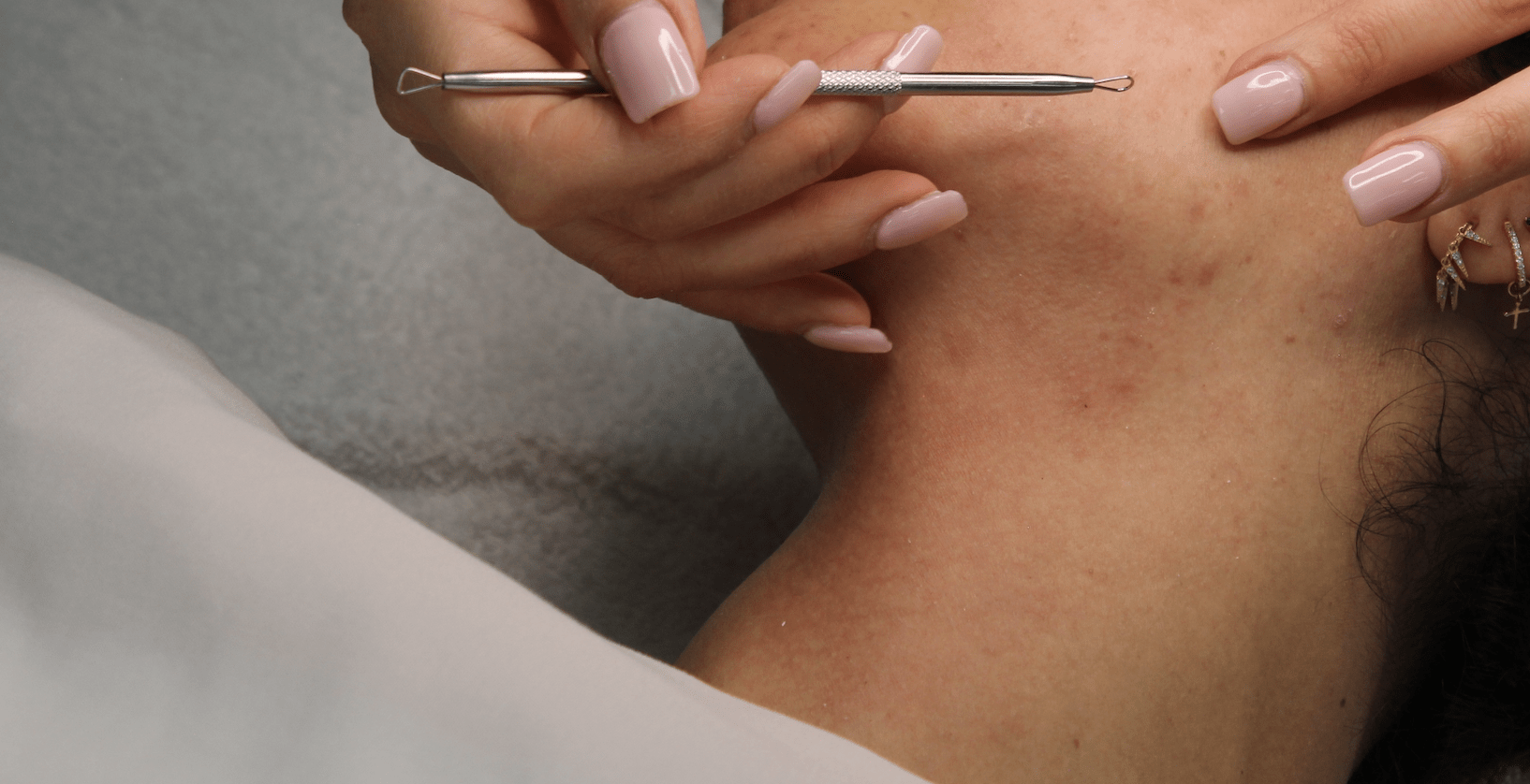 facial extractions on the cheek.