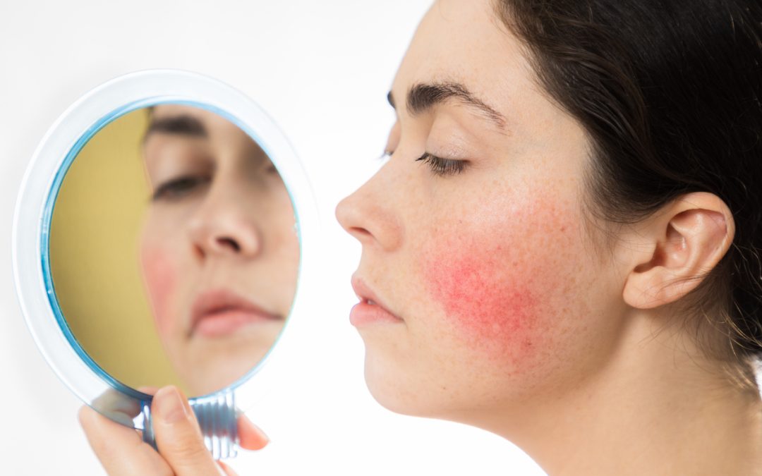 Rosacea Treatments in Winnipeg