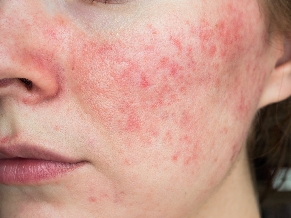 Rosacea Treatments in Winnipeg