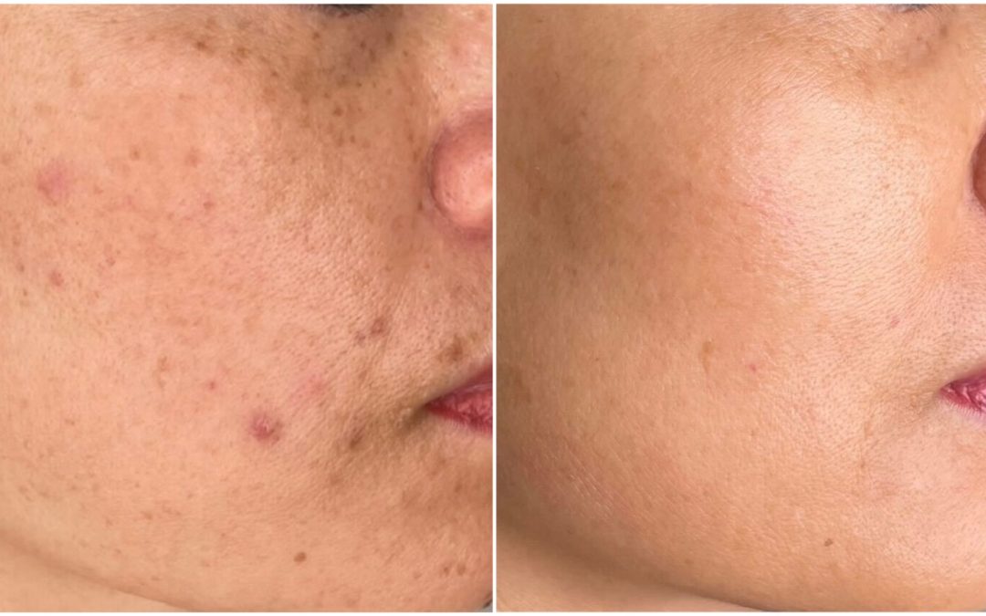 before and after hyperpigmentation treatment.
