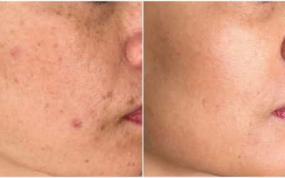 Best Treatments for Hyperpigmentation: A Deep Dive