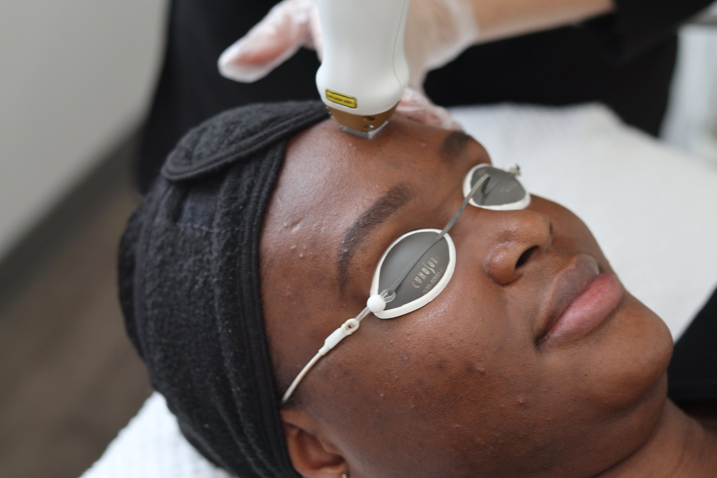 fractional laser service on a client's forehead.
