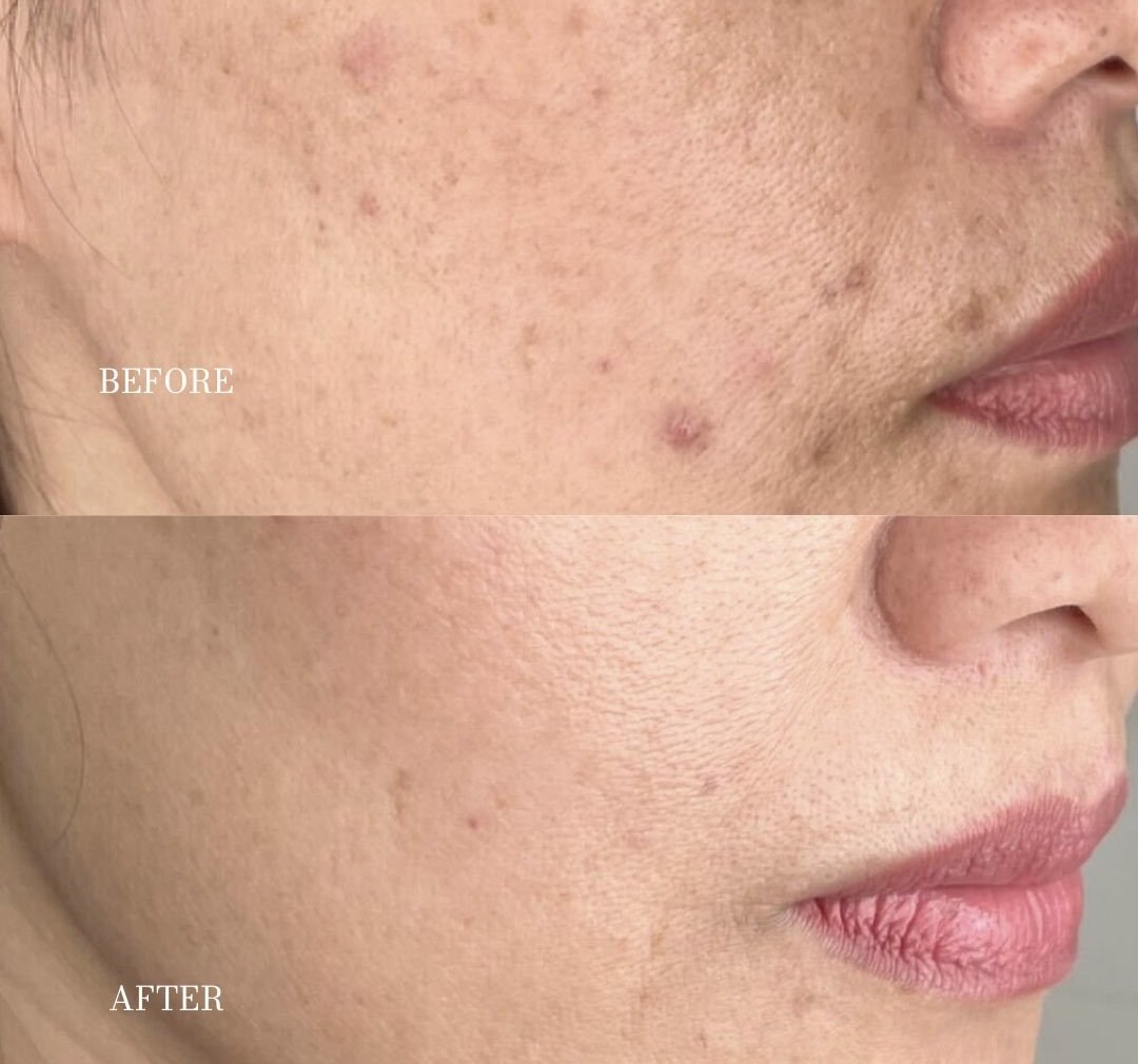 person with green eyes and freckles who knos how to prevent hyperpigmentatiion