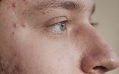 Anti-Acne: The Expertly Curated Acne Treatment & Product Pairing